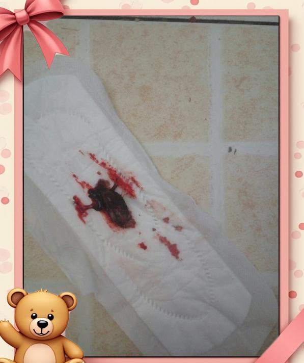 药流后有残留但是不出血了.