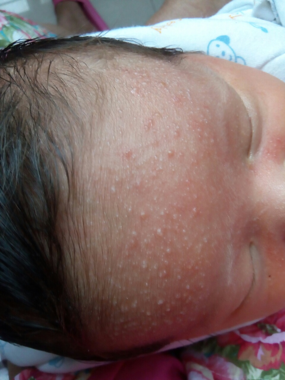 额头上长小米粒的小疙瘩