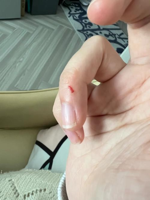 被仓鼠咬了,流血了,怎么办