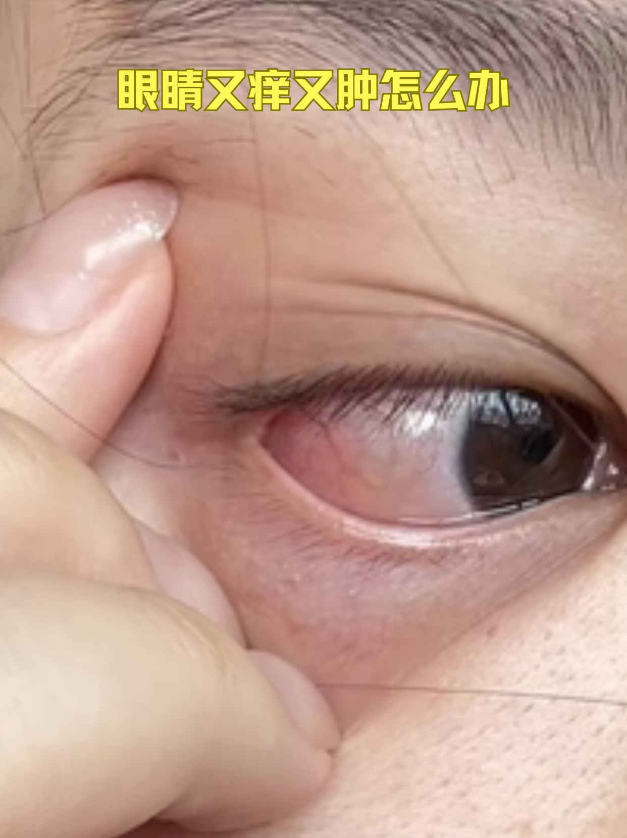 眼角红肿,痒痛是怎么回事?