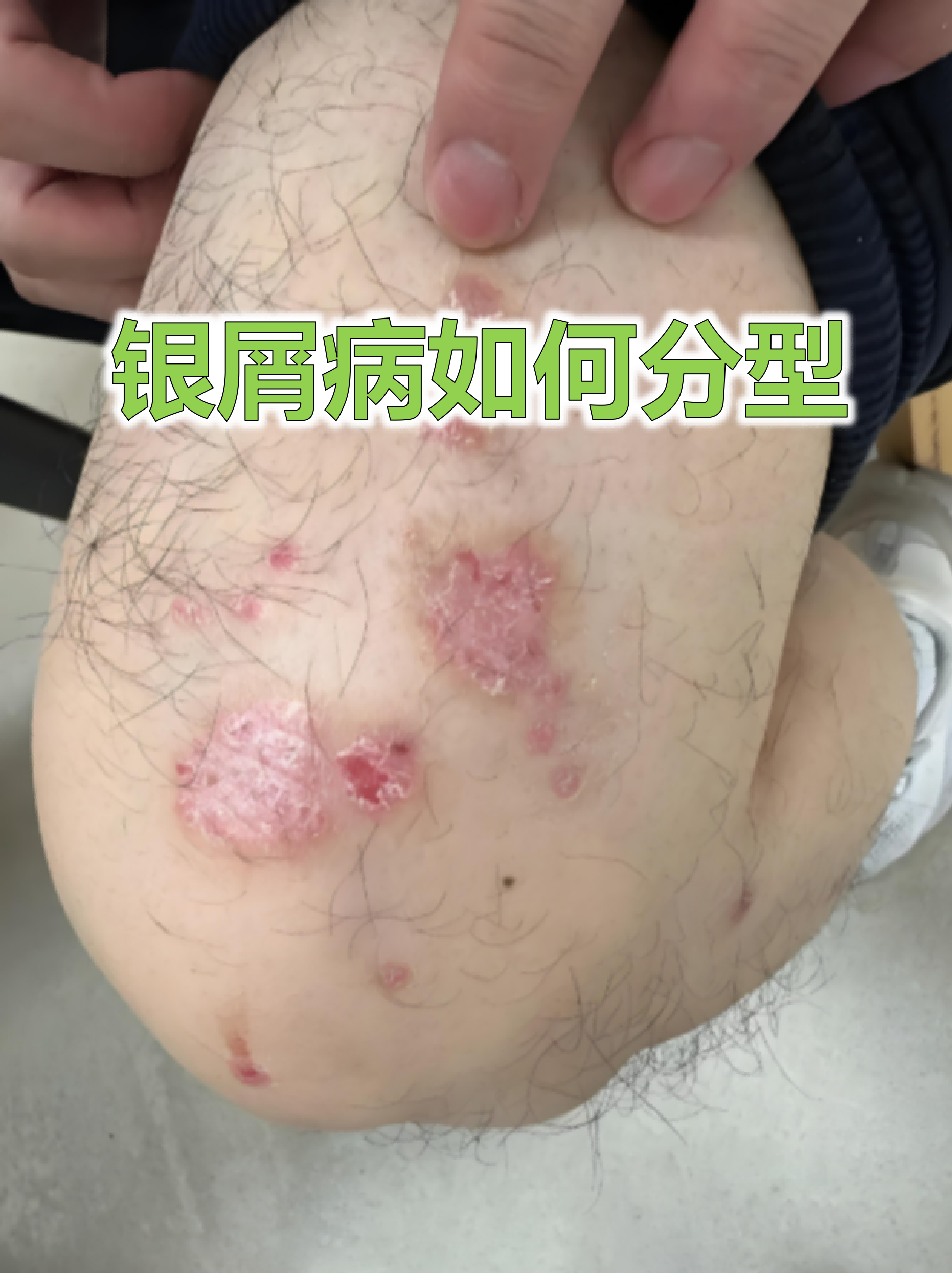 银屑病患者如何治疗