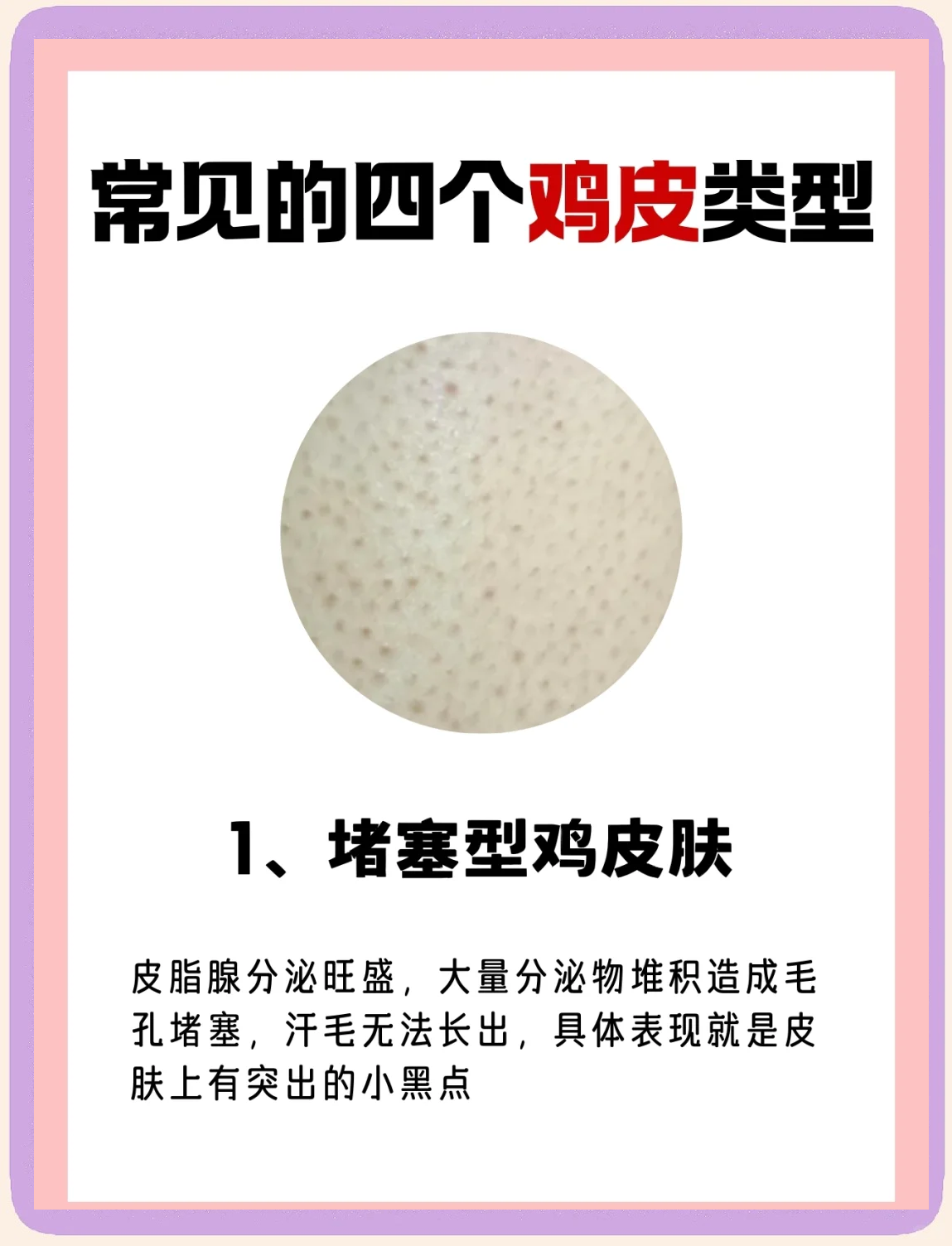 毛周角化症怎么能根治