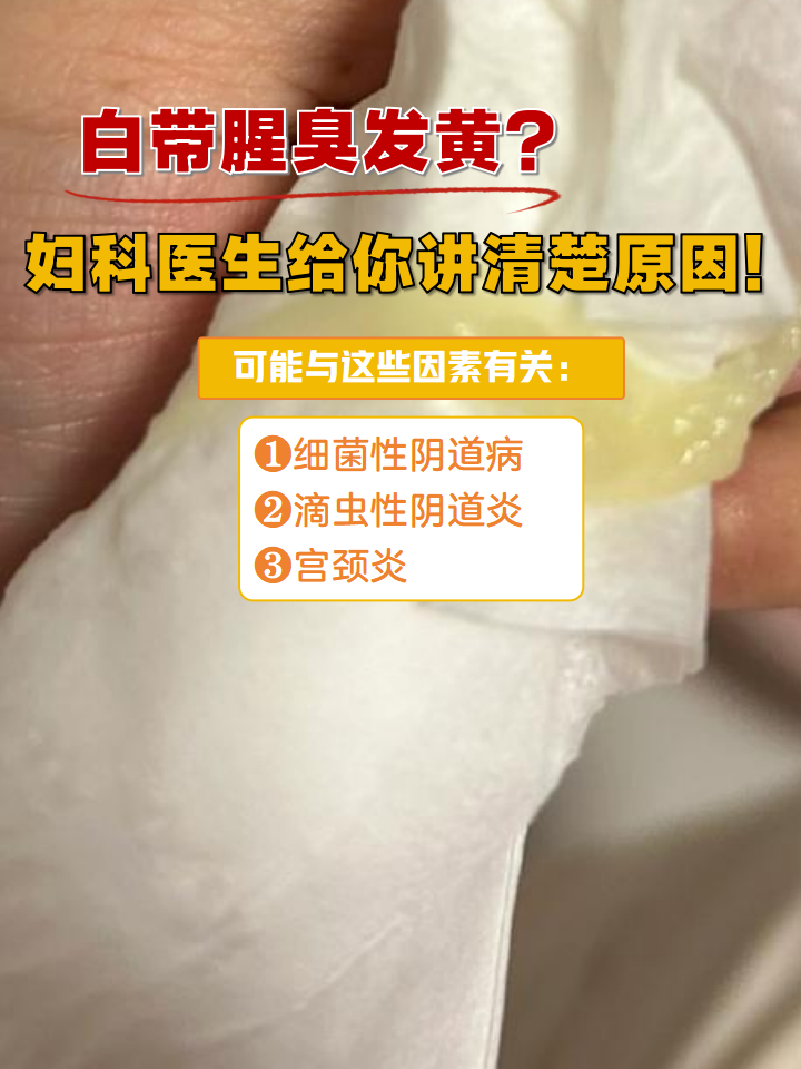 白带黄是怎么回事