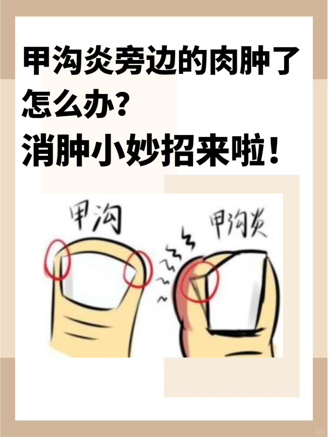 脚趾甲往肉里长怎么办