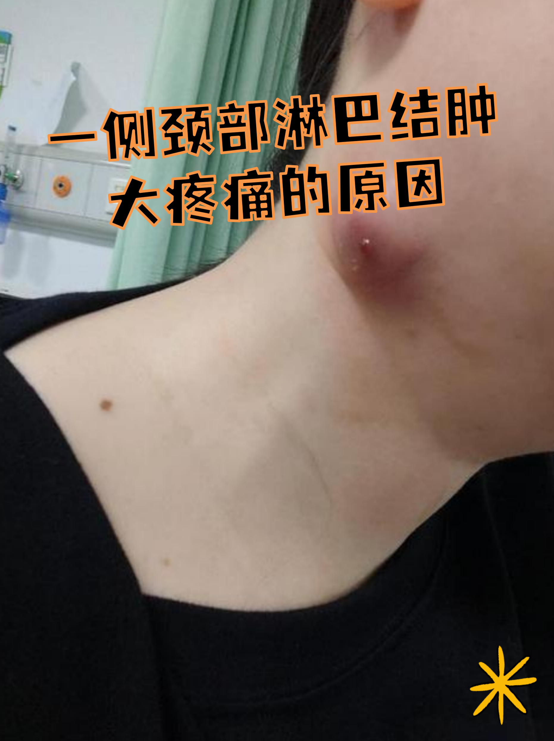 颈部淋巴痛是怎么回事