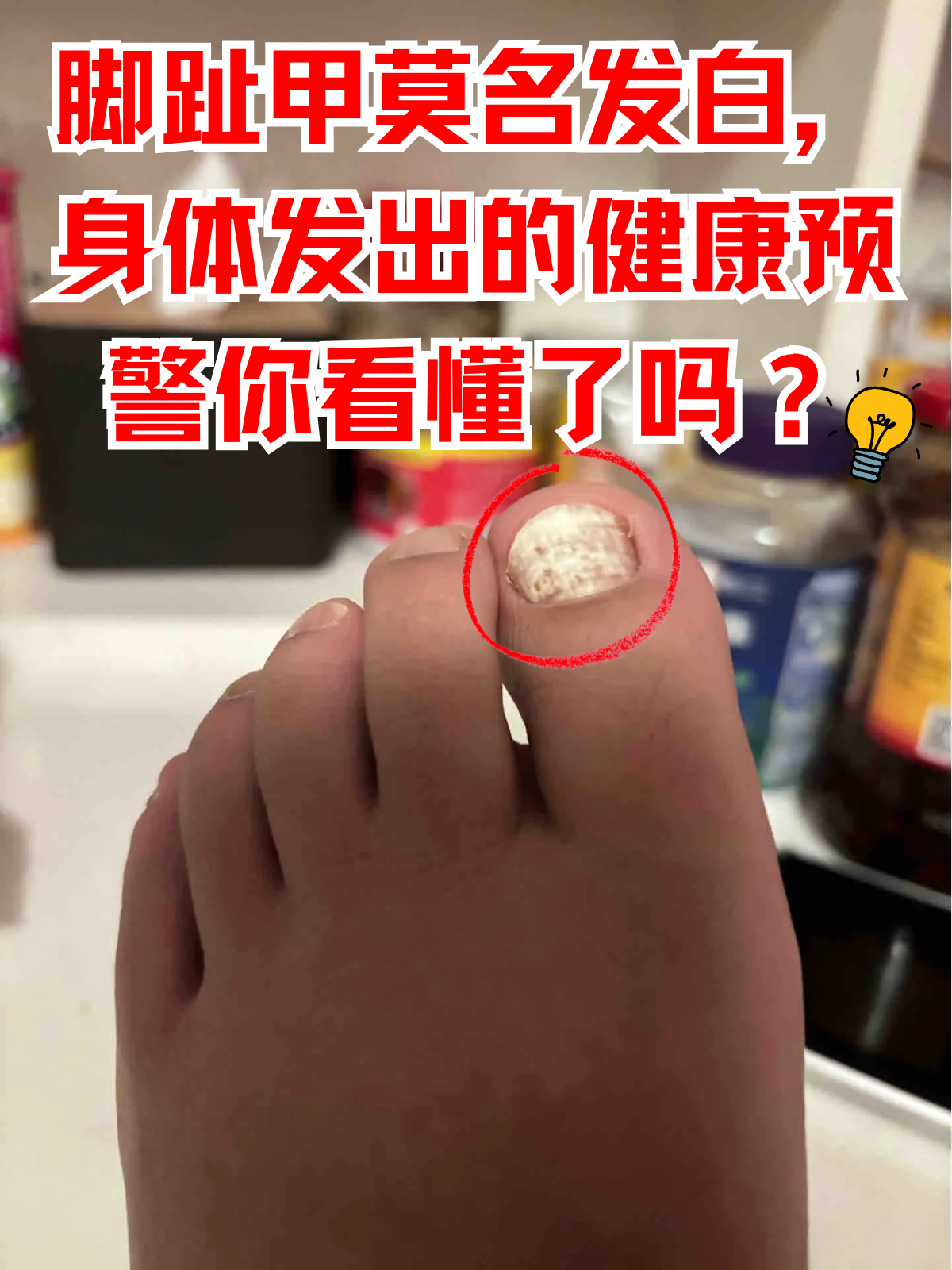 脚趾甲变黄怎么回事