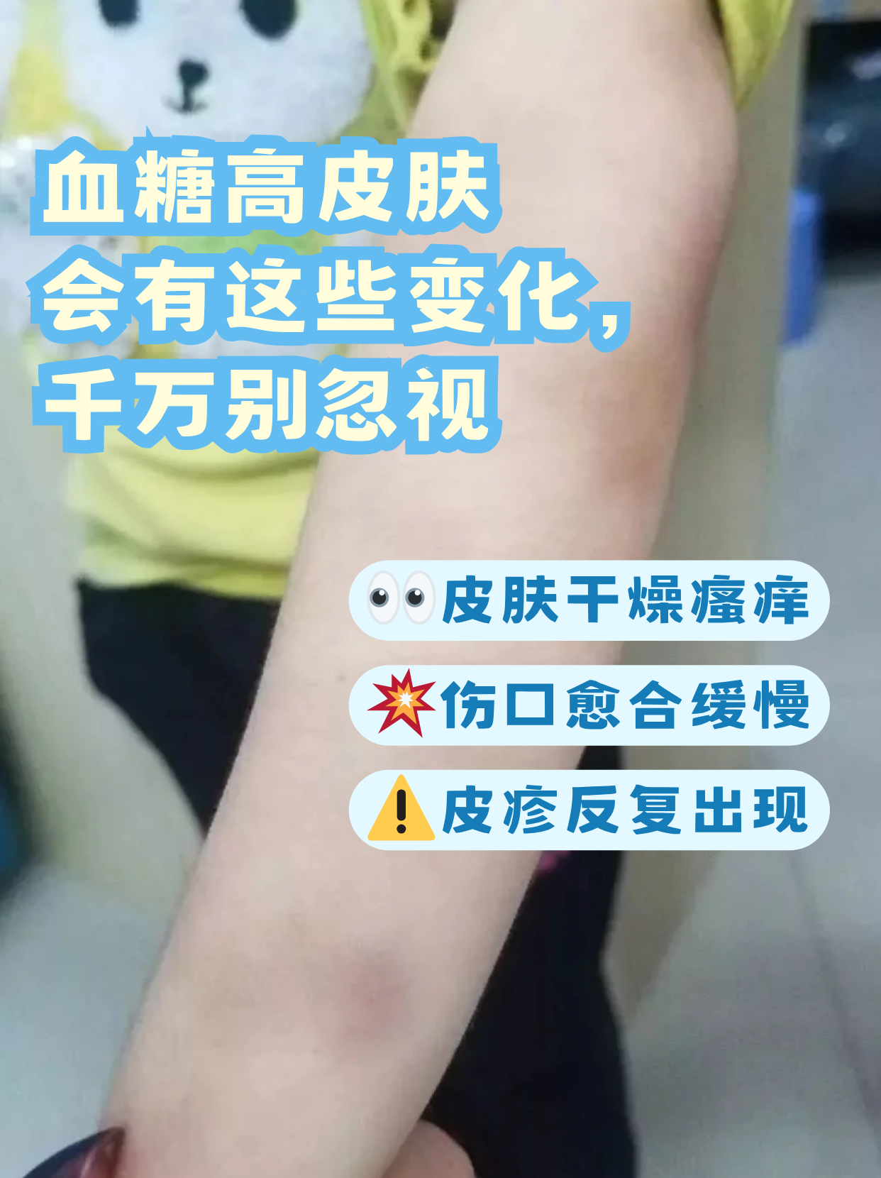 高血糖有哪些表现症状