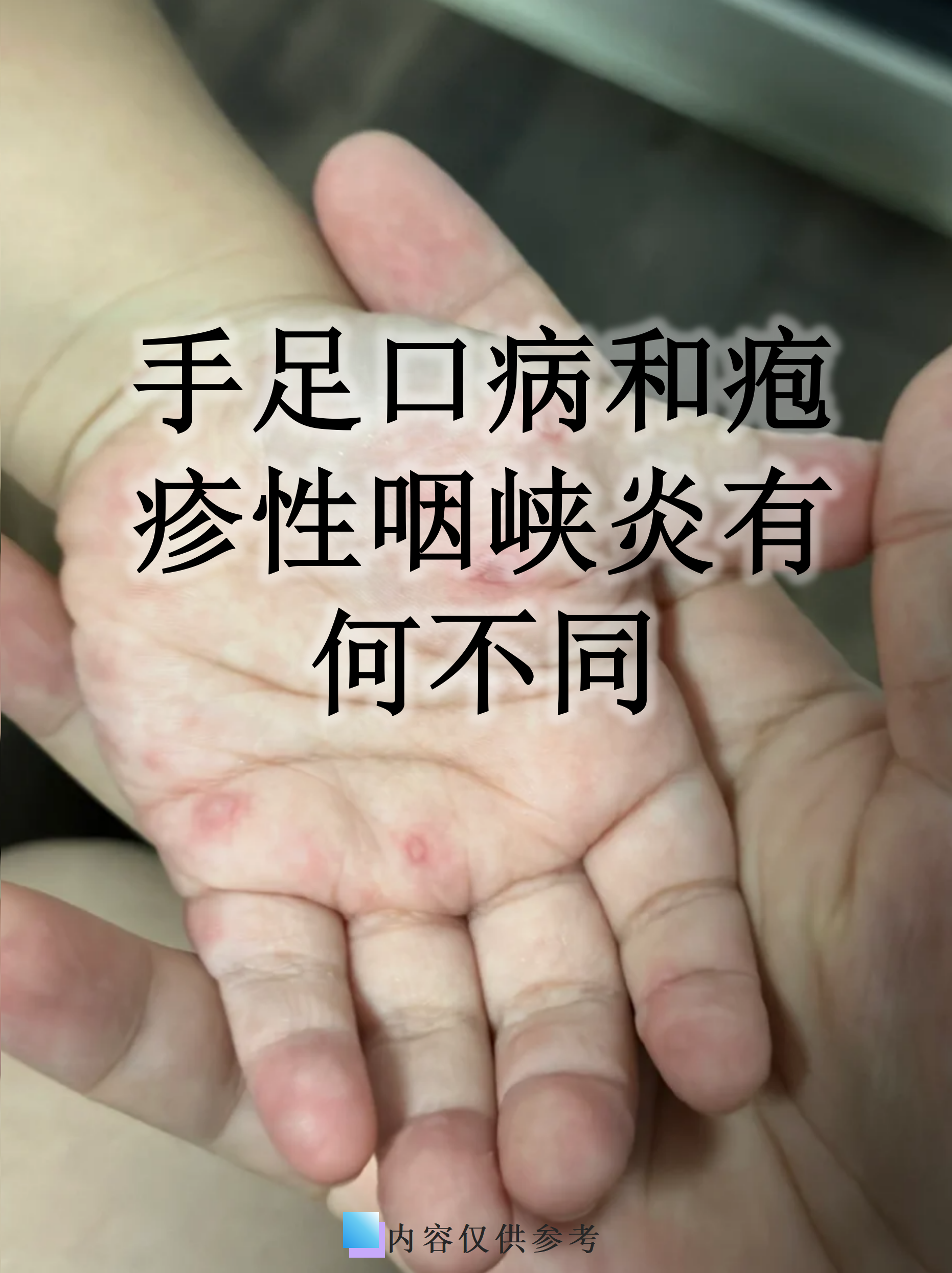 小孩手足口病的主要症状?