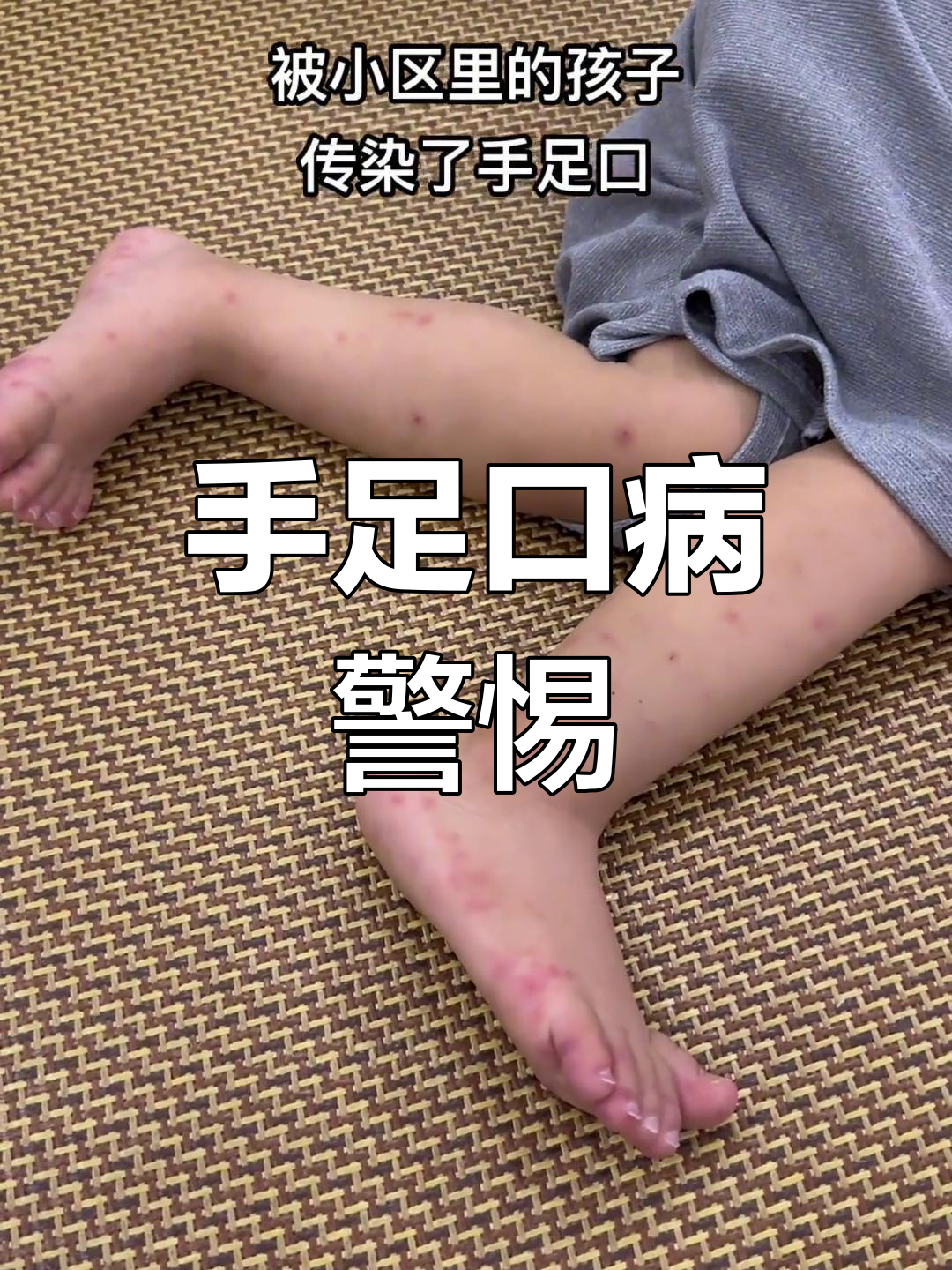 小孩手足口病的主要症状?