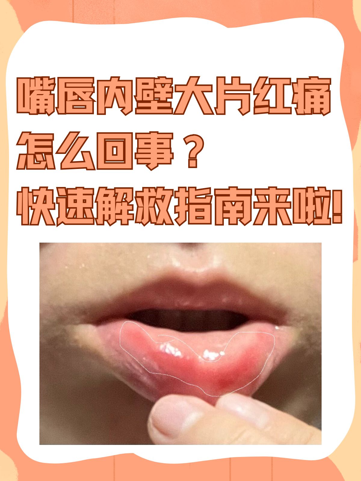 上唇肿了,如何快速消肿