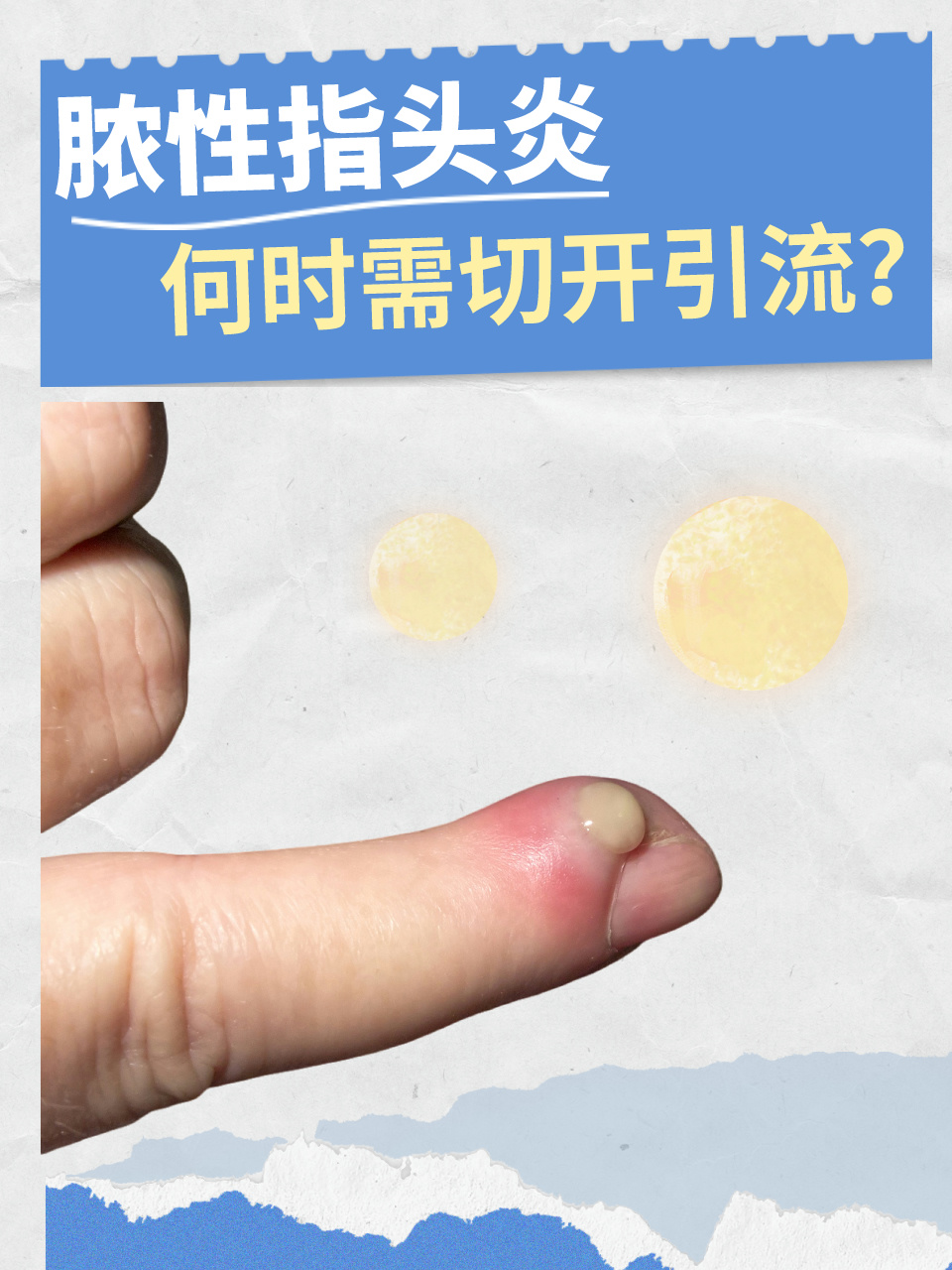 伤口发炎怎么处理