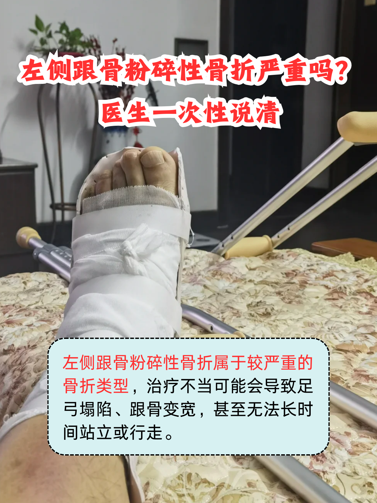 跟骨粉碎性骨折多少天走路