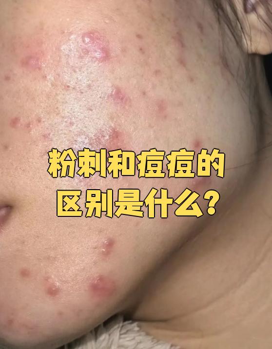 粉刺是什么?