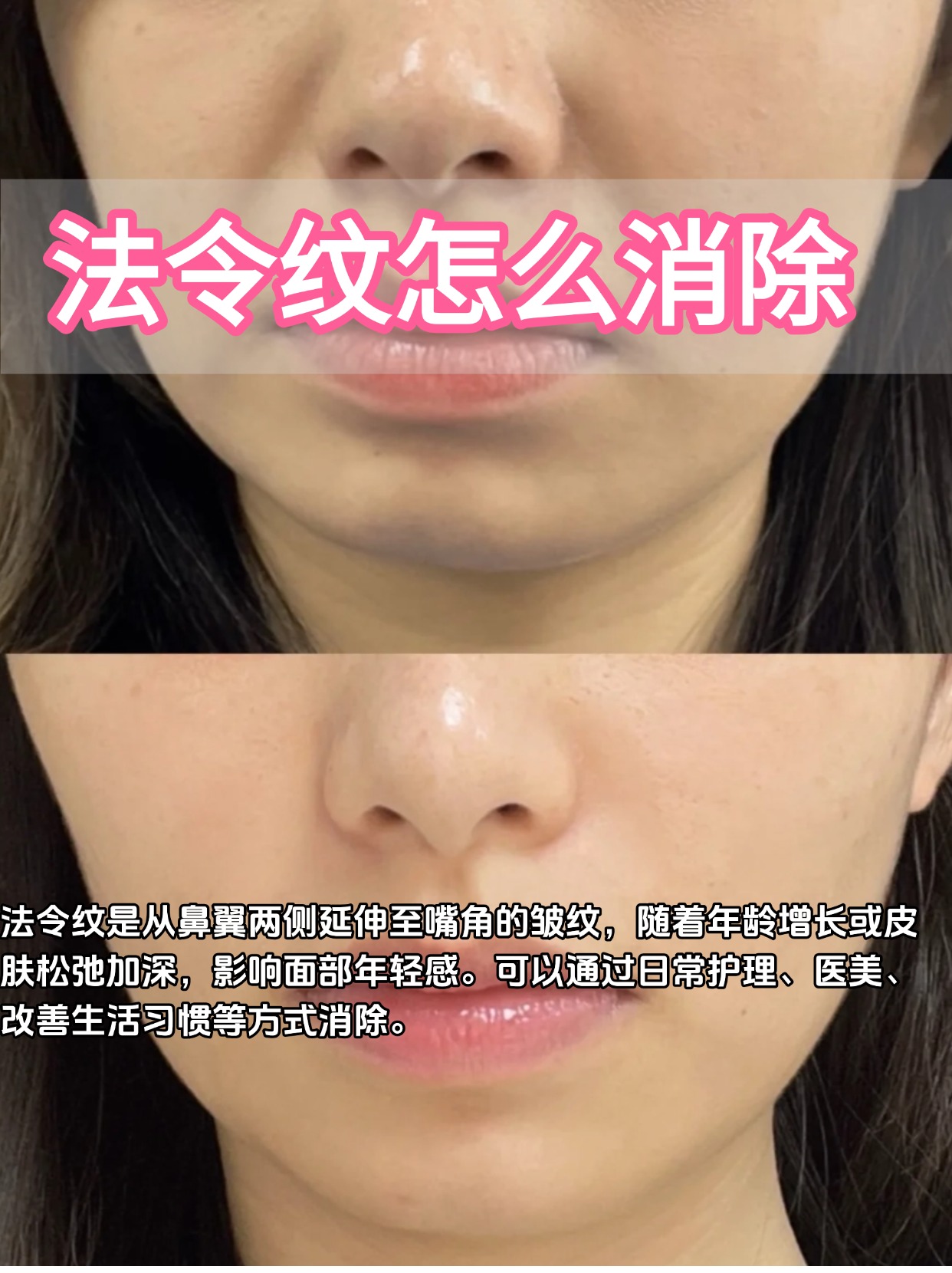 法令纹如何消除