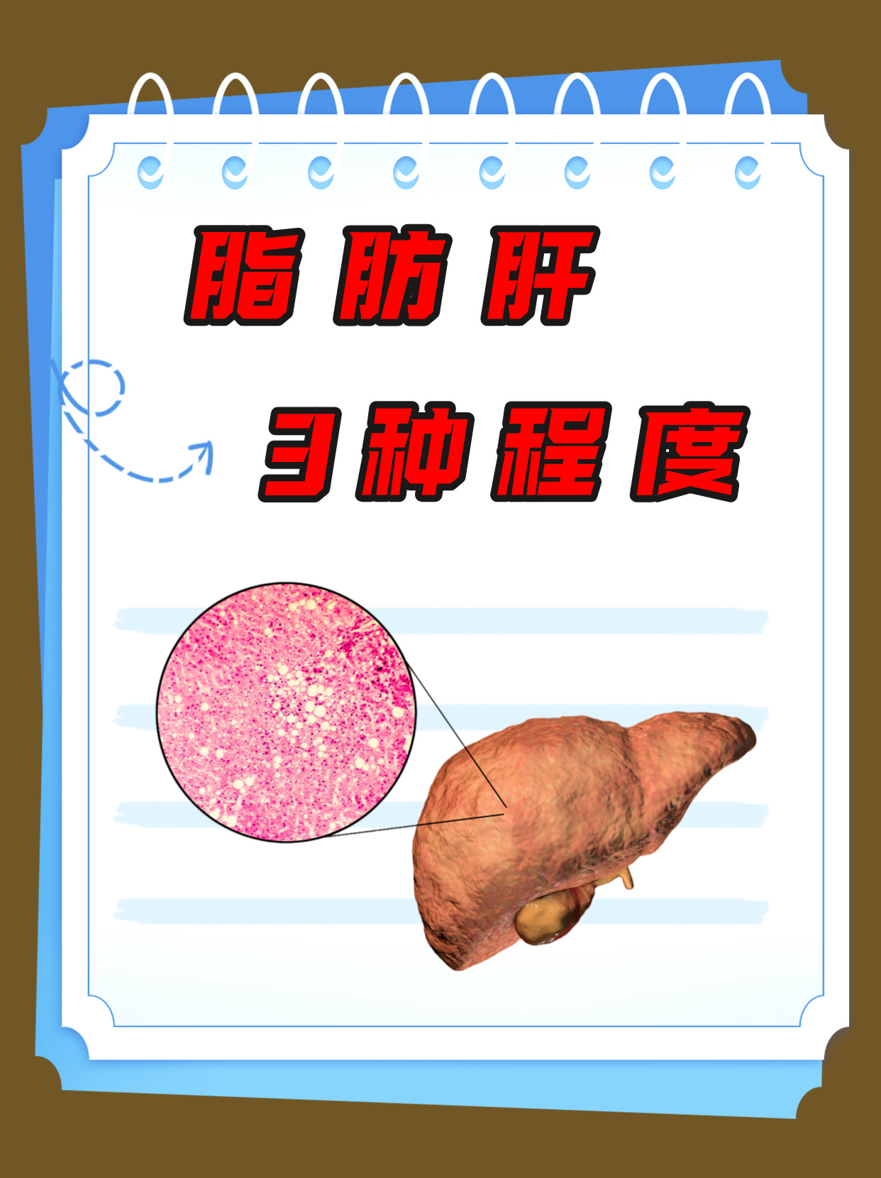 中度脂肪肝怎么调养