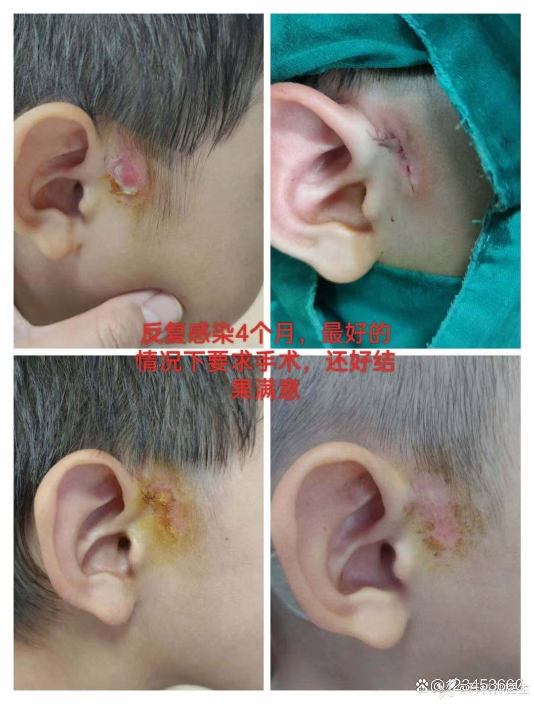 耳前瘘管一定要手术吗