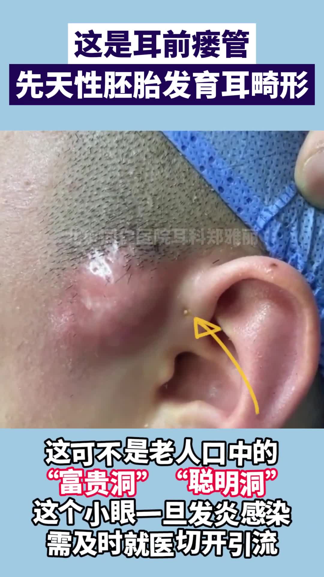 耳前瘘管一定要手术吗