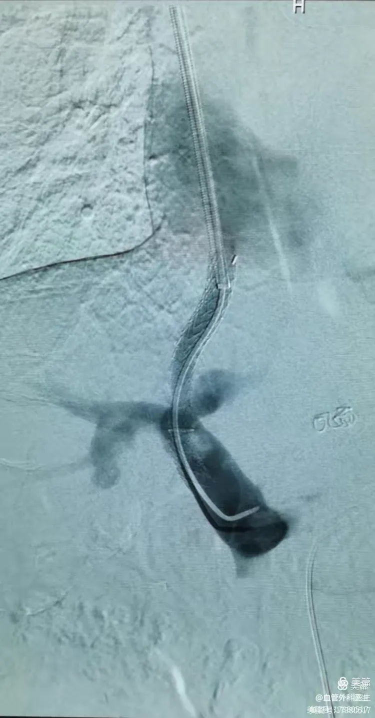 门脉高压断流手术利弊