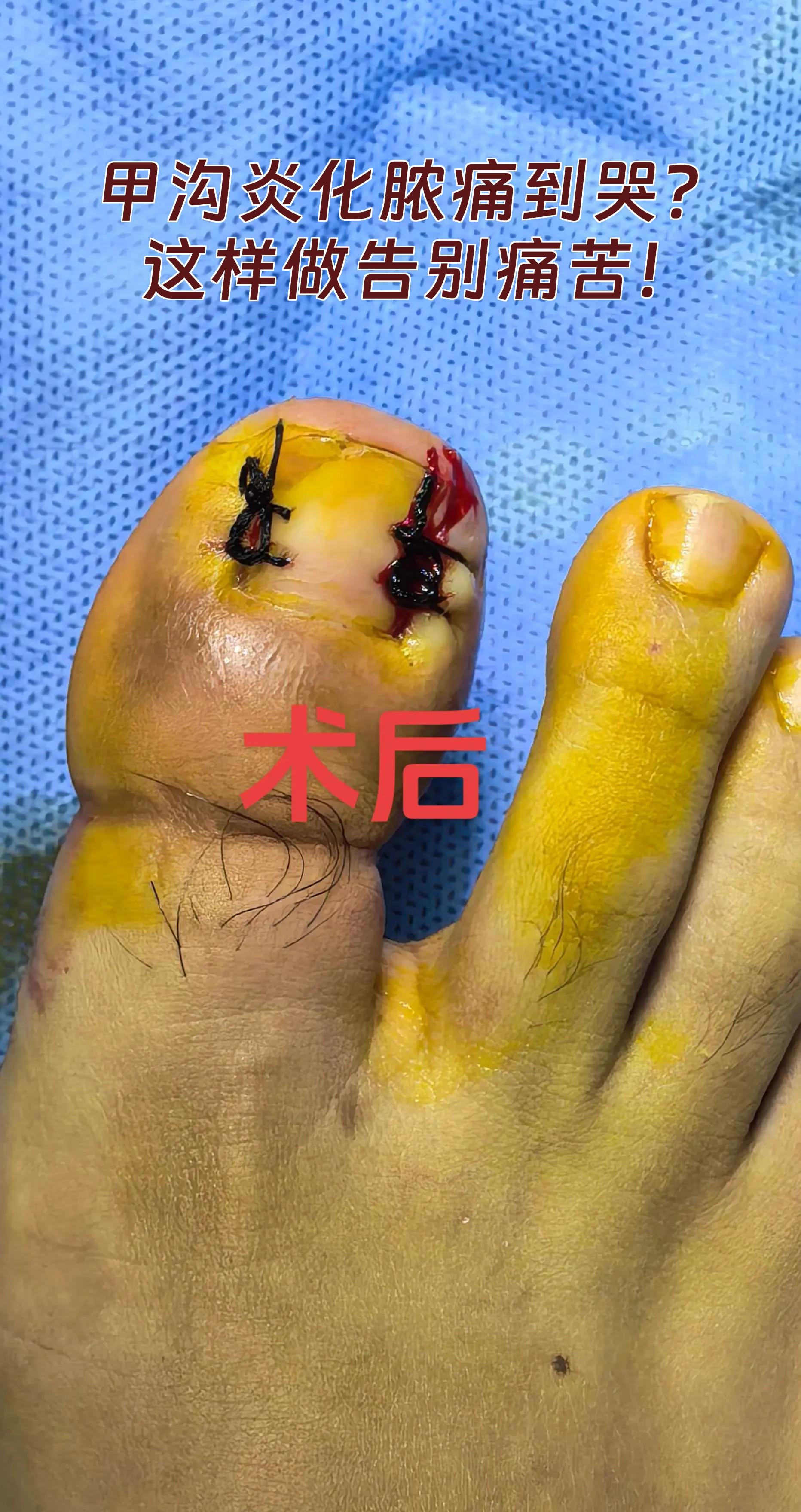 甲沟炎,有碘伏能治好吗