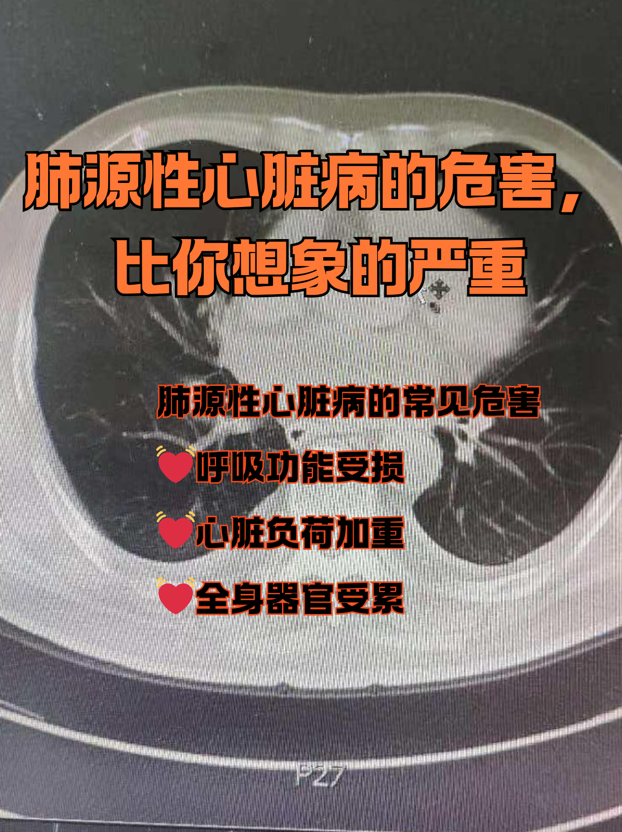 肺心病的晚期症状