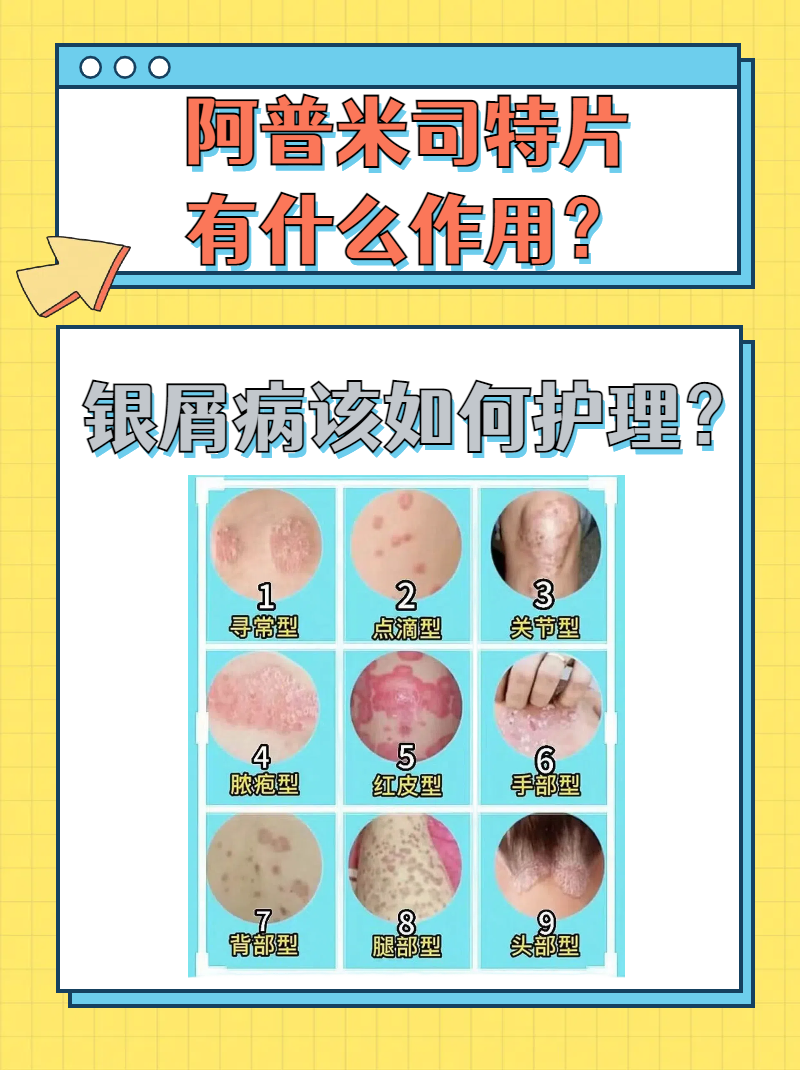 银屑病如何治疗?