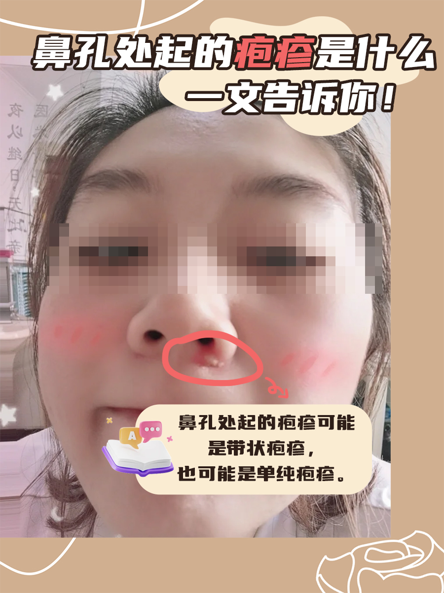 鼻孔里面长痘痘怎么办