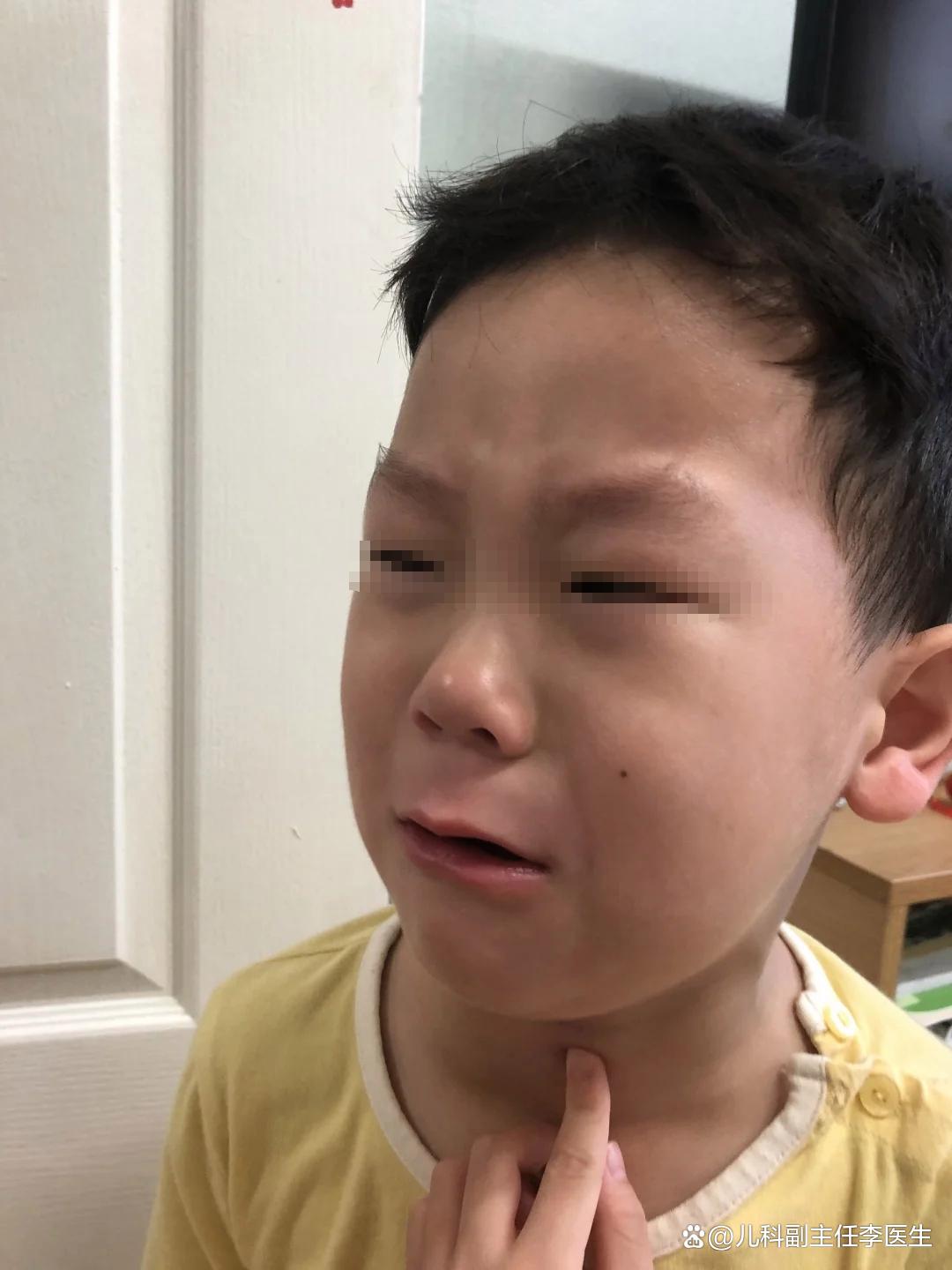 儿童咽喉炎