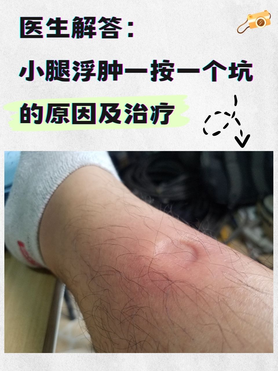 全身浮肿是什么原因引起的