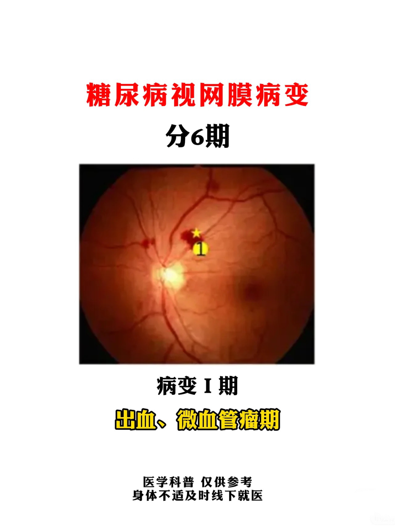 糖尿病慢性并发症的主要表现