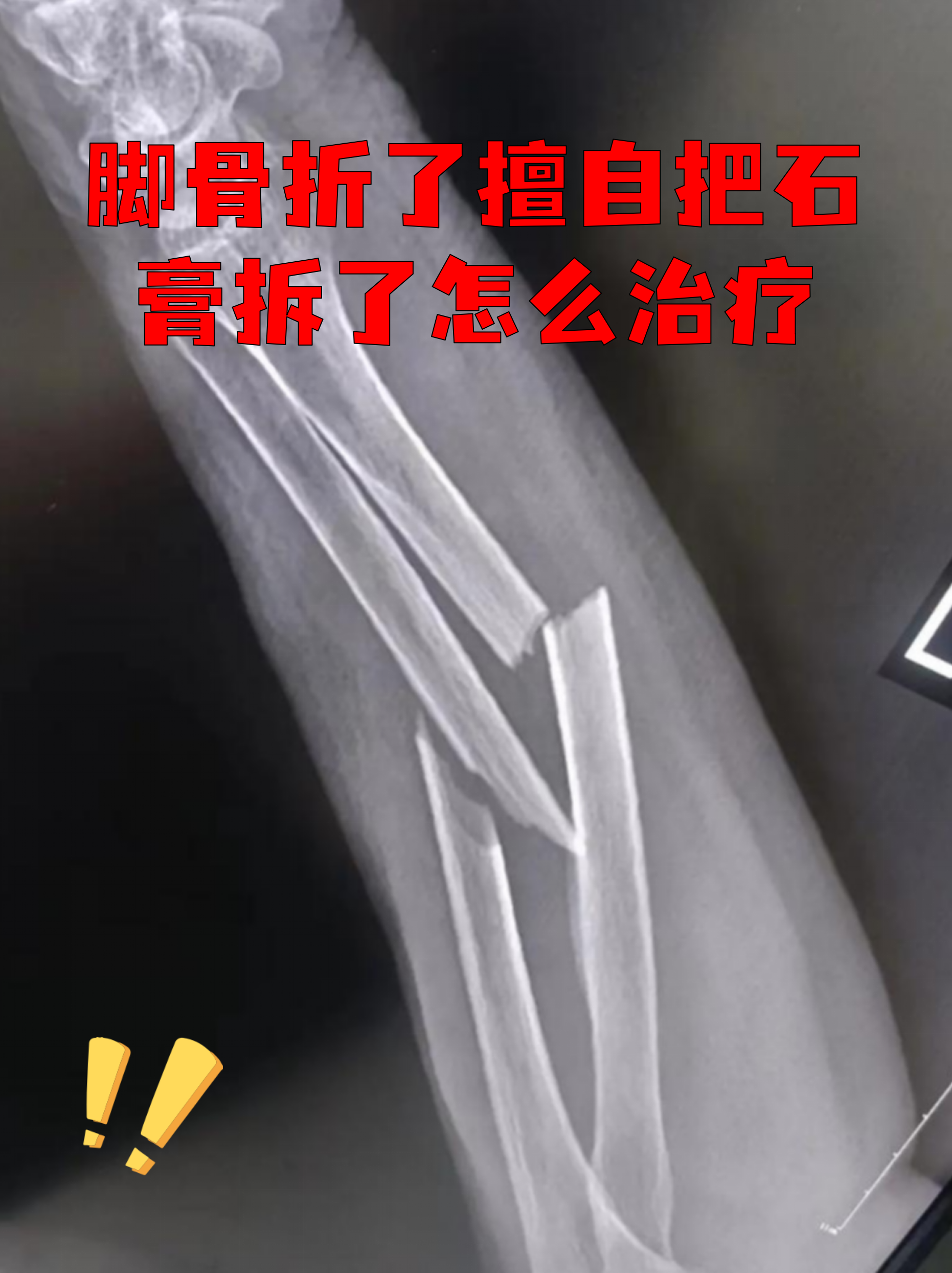 骨折打了石膏一般多长时间能拆