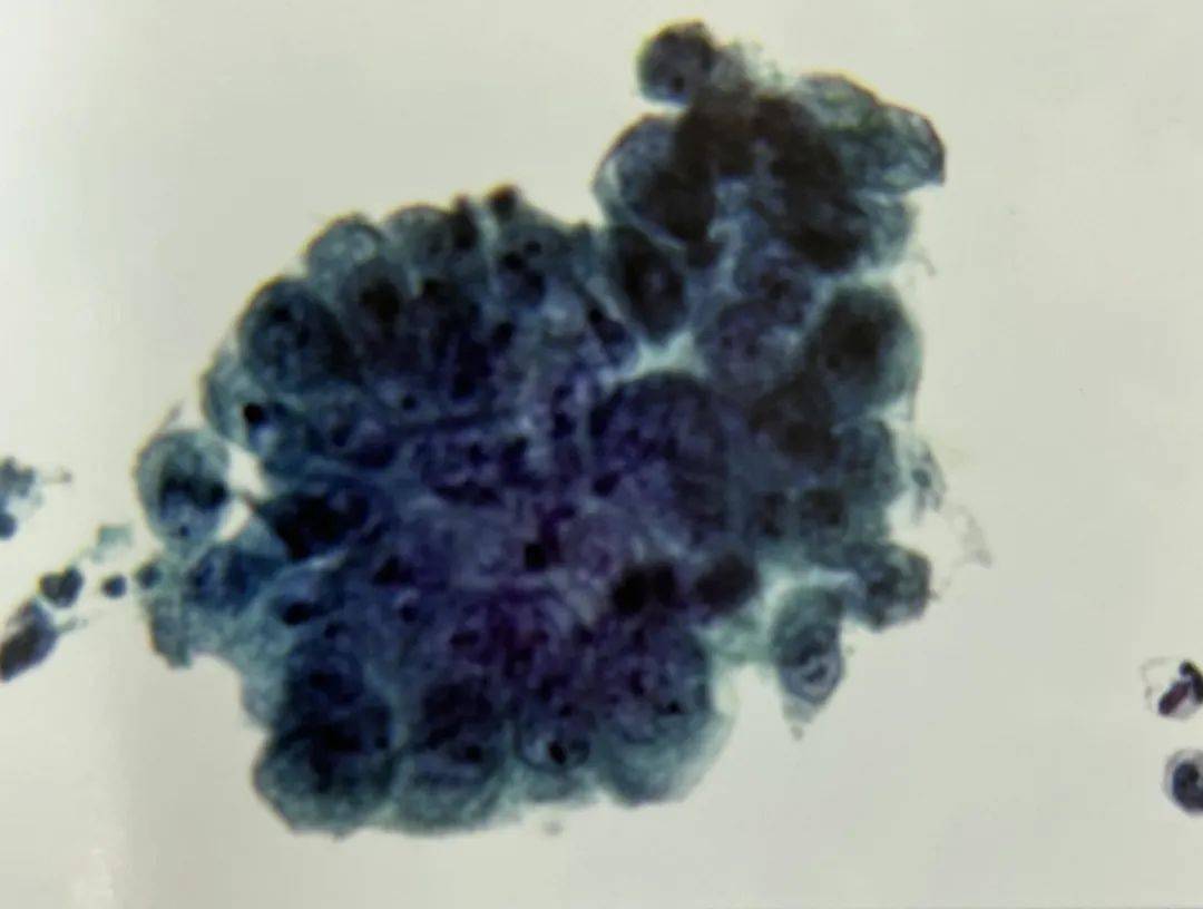 外阴鳞状上皮细胞增生是什么意思