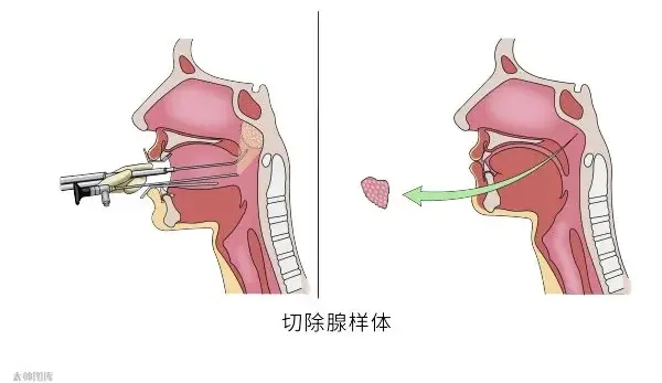 扁桃体手术疼吗