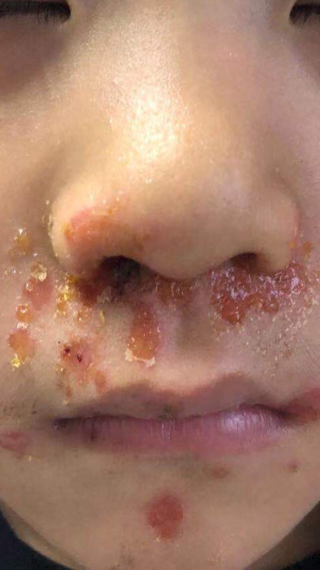 黄皮疮怎么治怎么引起的