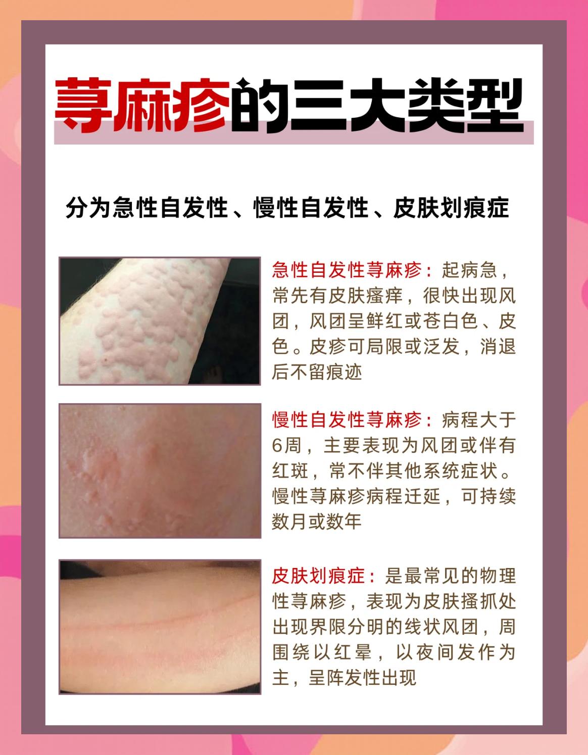 人工荨麻疹能彻底根治吗