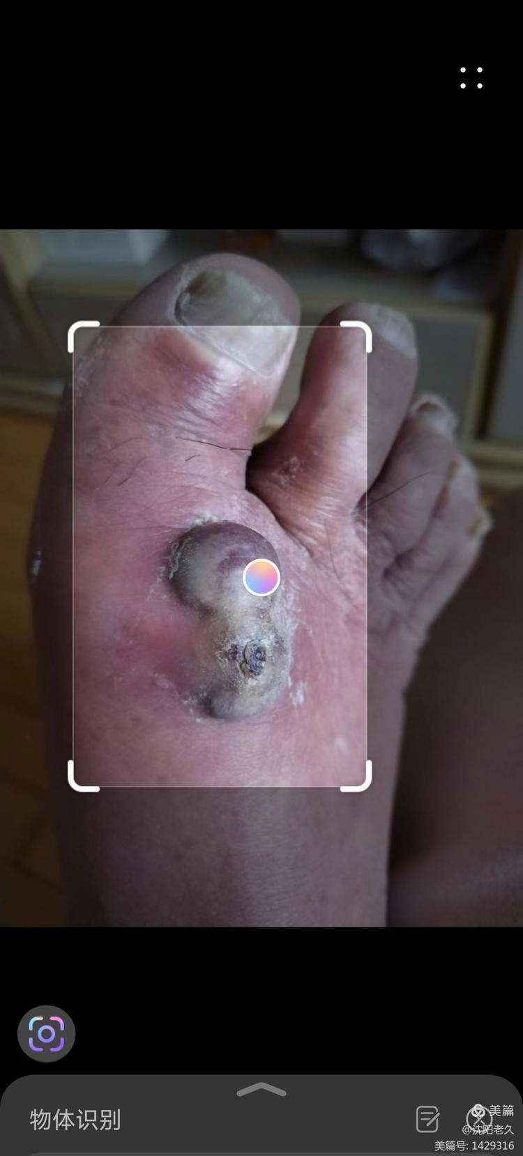 糖尿病足的早期症状