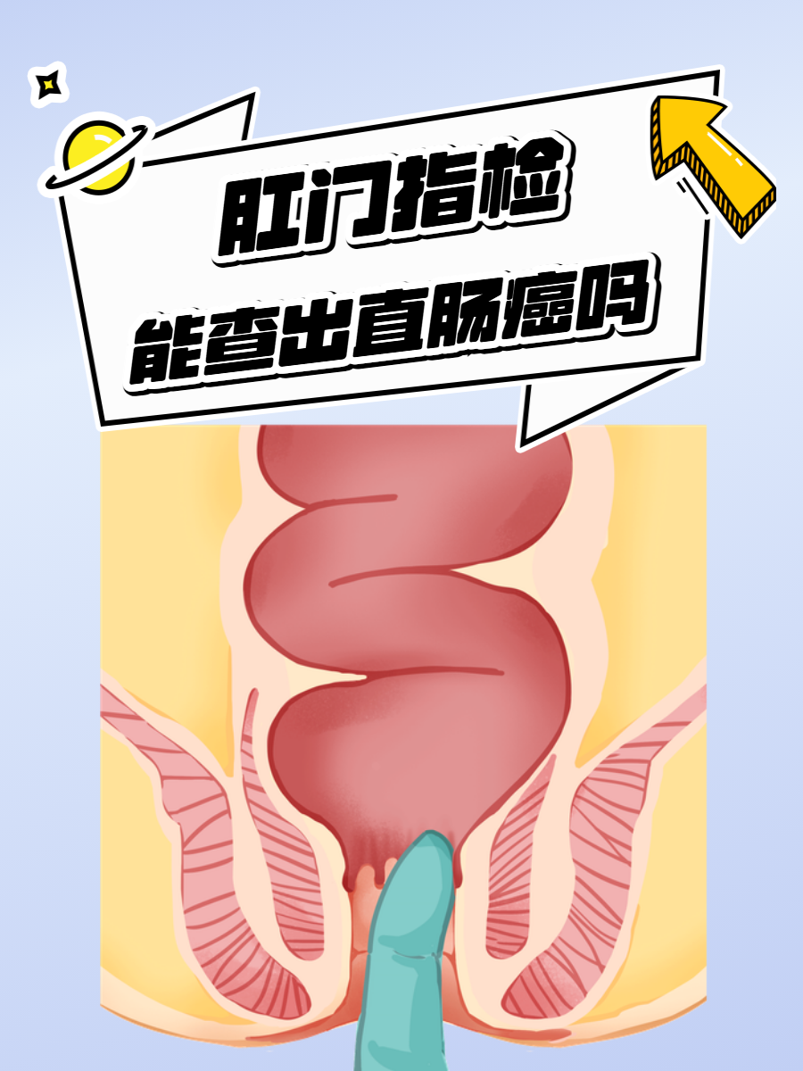 肛门检查怎么查
