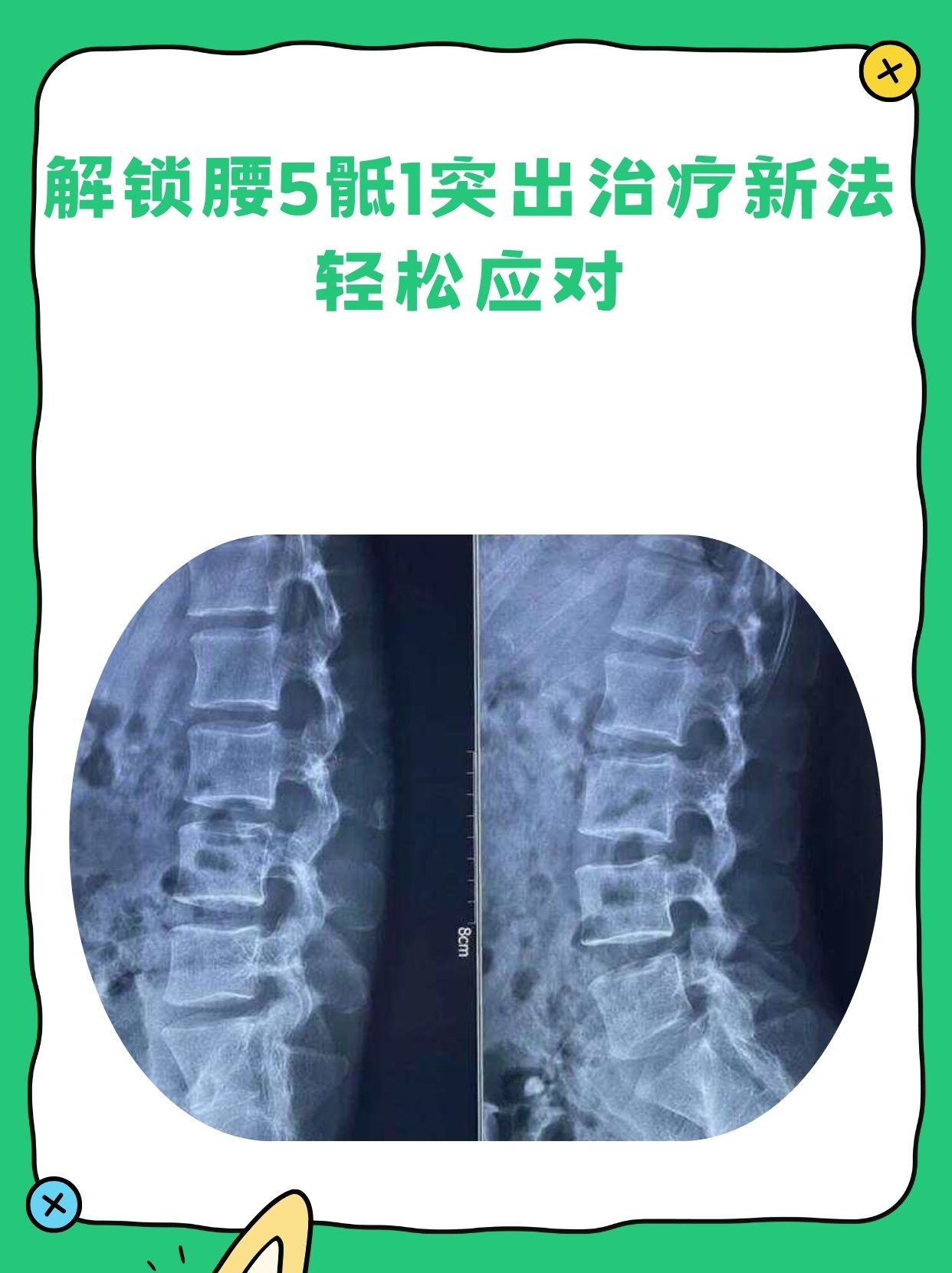 治疗腰椎间盘突出症状