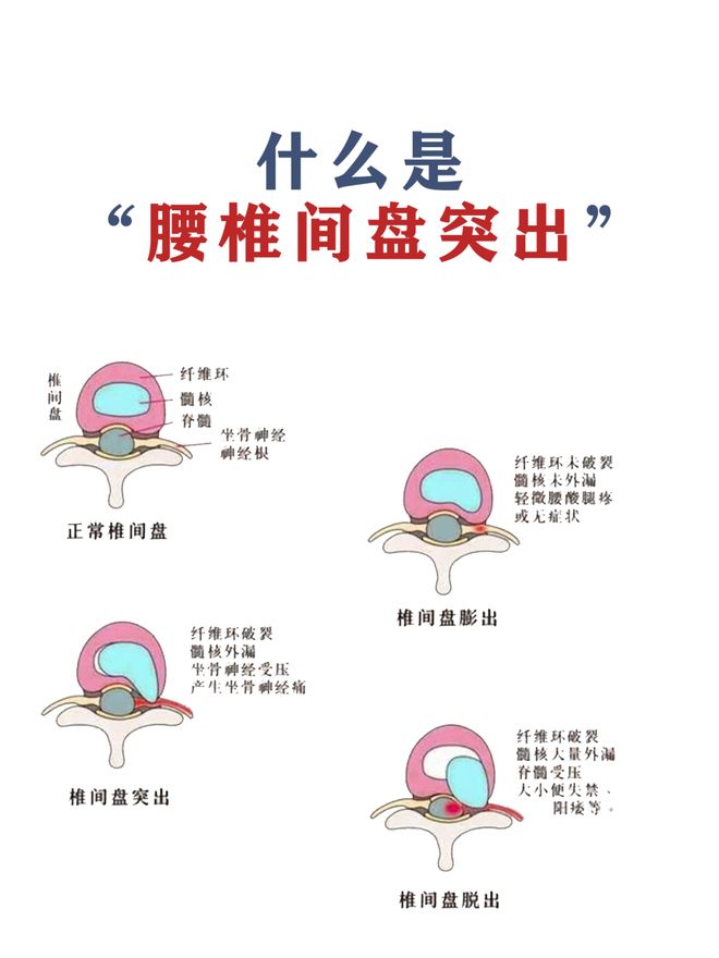 治疗腰椎间盘突出症状