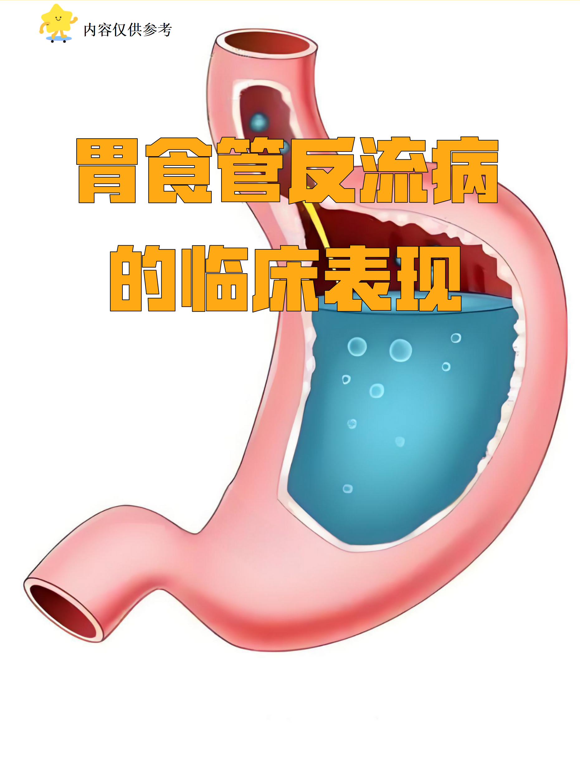 胃食管反流的症状有哪些