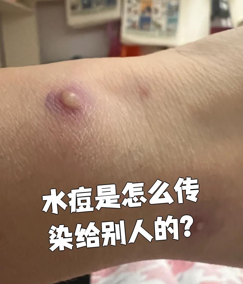 水痘通过什么途径传染