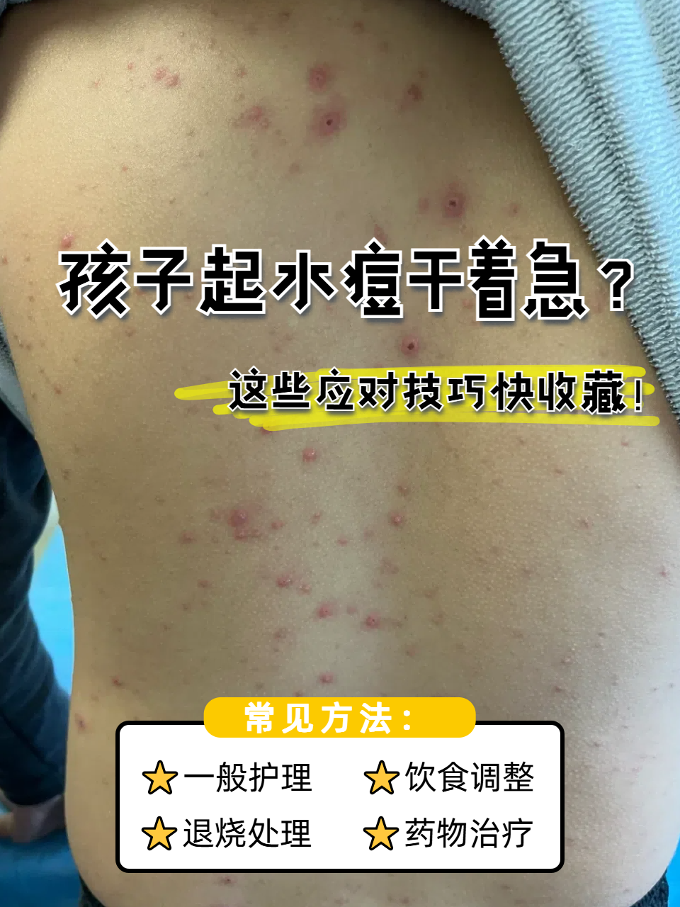 水痘通过什么途径传染