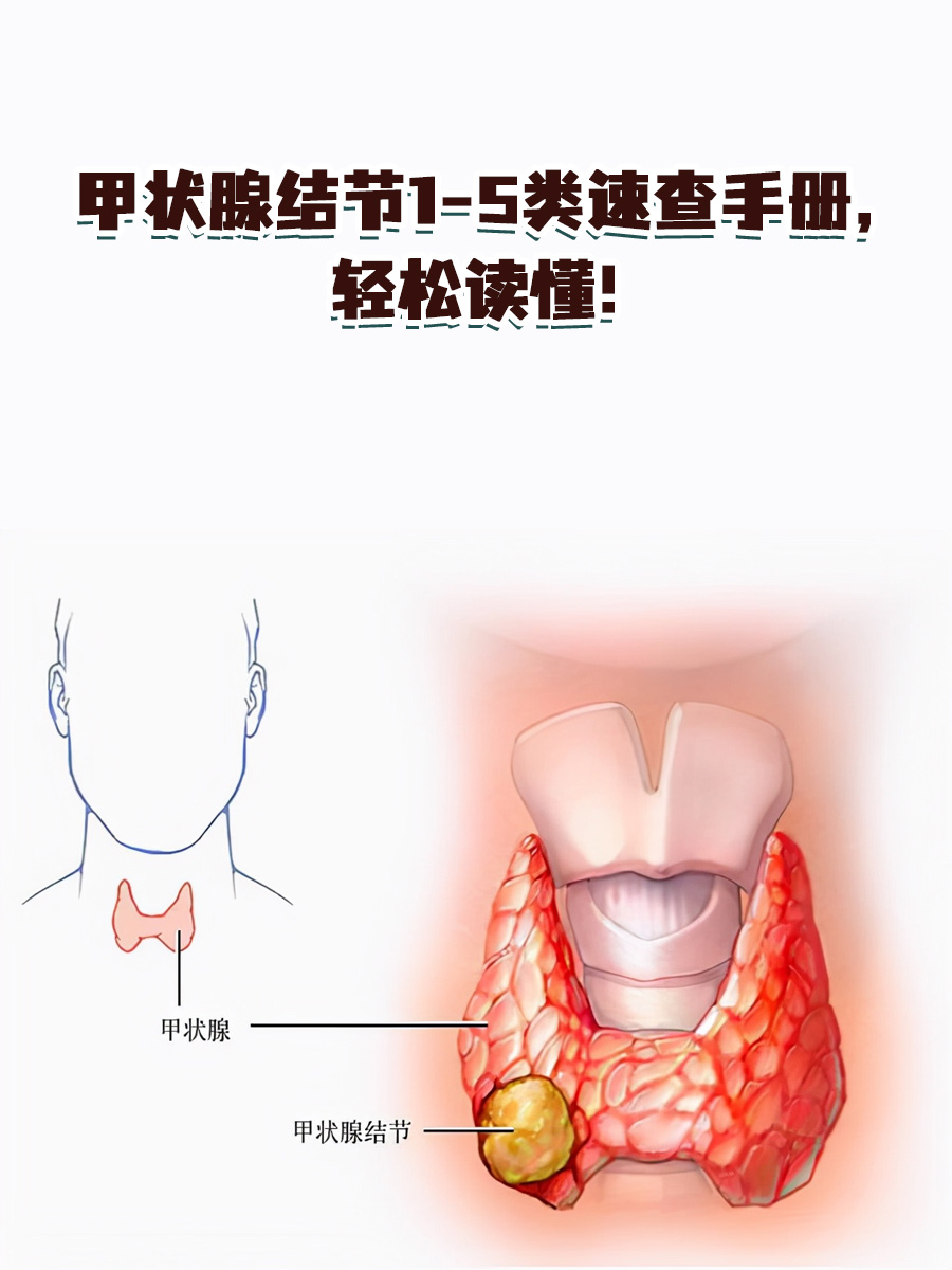 甲状腺囊实性结节(3类)