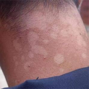 汗斑早期症状图片