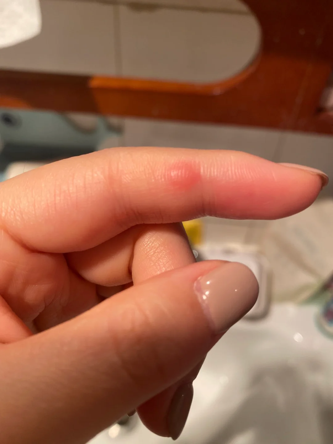 手上长了个硬疙瘩怎么办