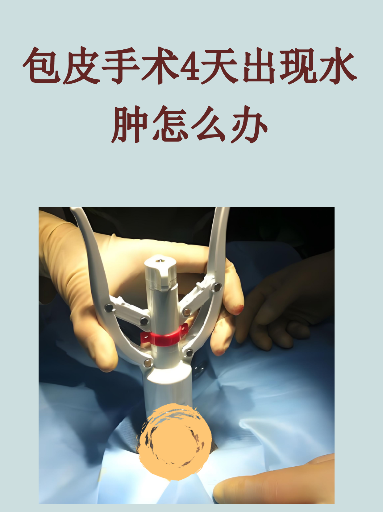 包皮术后水肿怎么办?