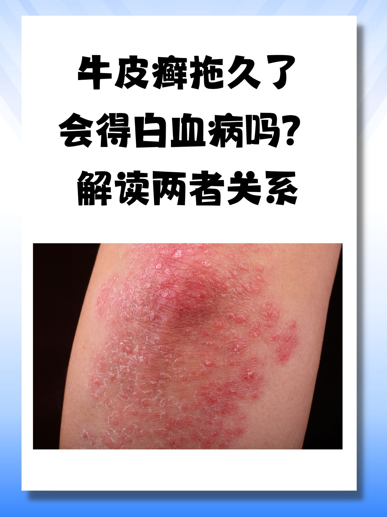 银屑病怎么治好的比较快