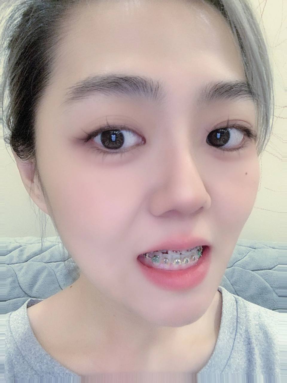 带牙套多少岁合适