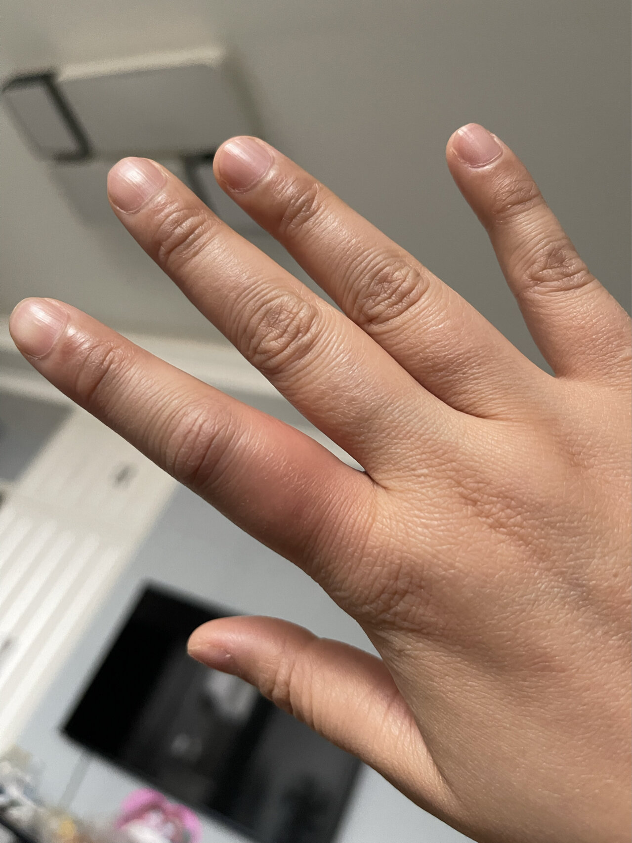 手指头肿胀怎么回事?