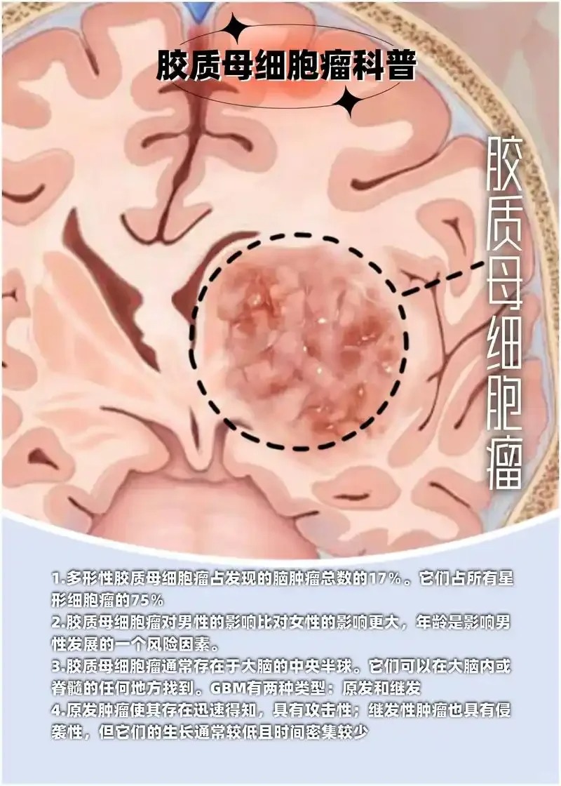 胶质瘤母细胞四级怎么办