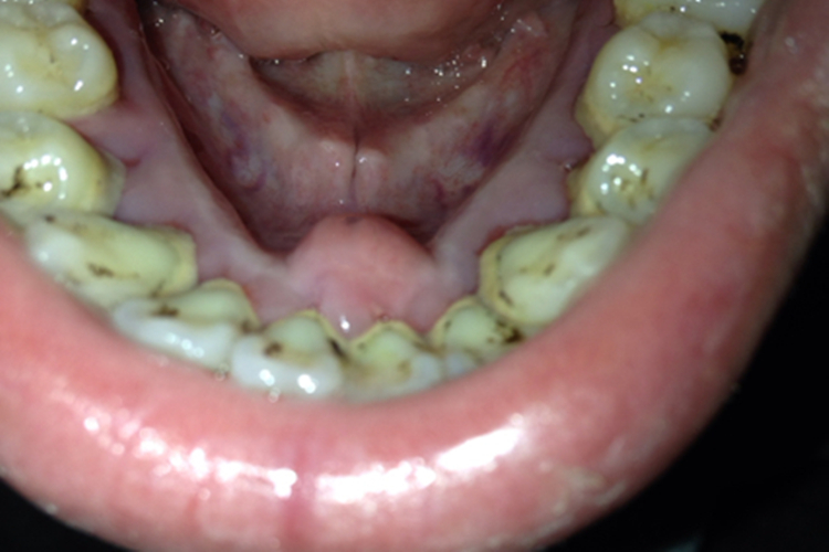 牙龈上有突起,摸上去硬